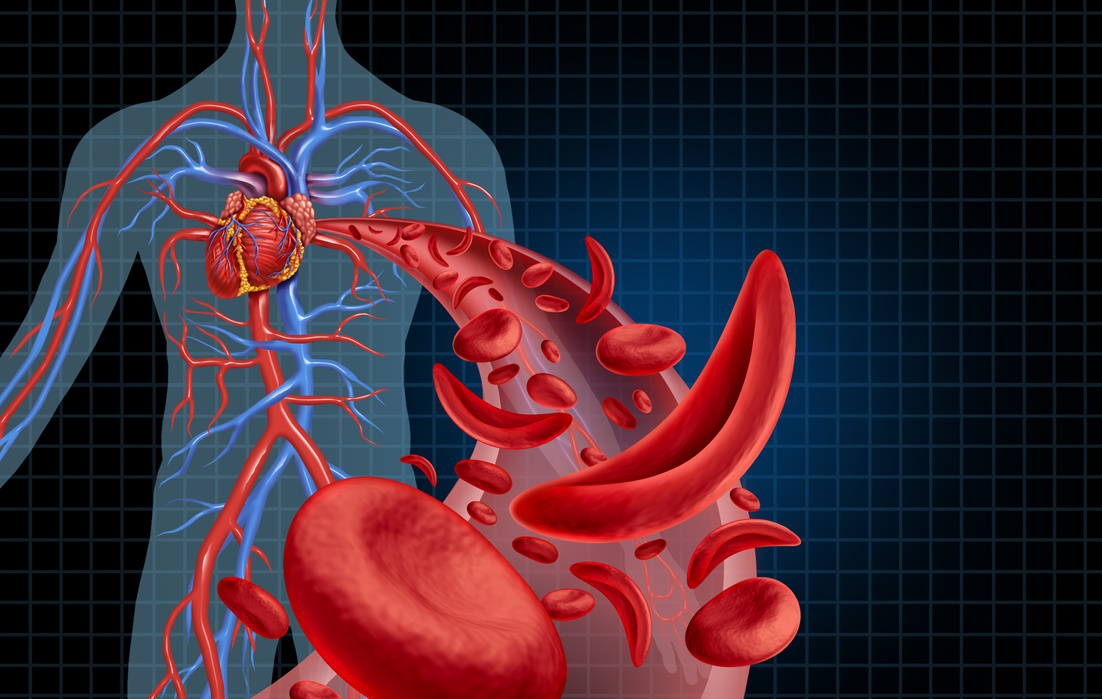 Sickle Cell Cardiovascular